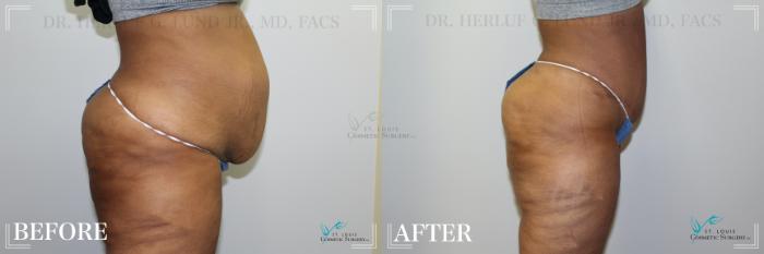 Before & After Tummy Tuck Case 223 Right Side View in St. Louis, MO