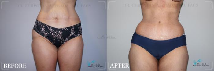 Before & After Tummy Tuck Case 226 Front View in St. Louis, MO