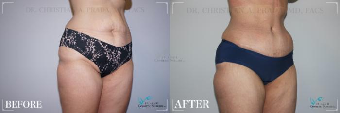 Before & After Tummy Tuck Case 226 Right Oblique View in St. Louis, MO