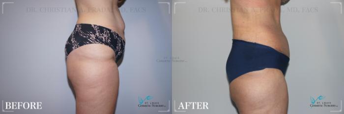 Before & After Tummy Tuck Case 226 Right Side View in St. Louis, MO