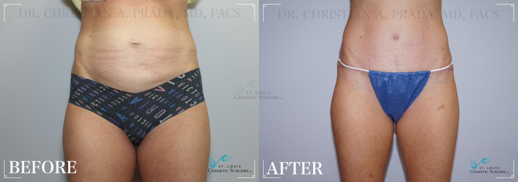 Before & After Tummy Tuck Case 227 Front View in St. Louis, MO