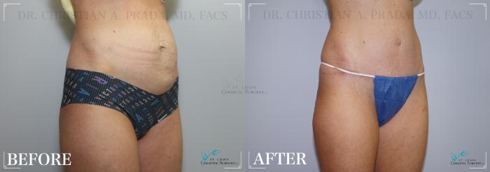 Before & After Tummy Tuck Case 227 Right Oblique View in St. Louis, MO