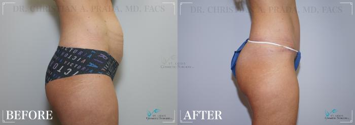 Before & After Tummy Tuck Case 227 Right Side View in St. Louis, MO