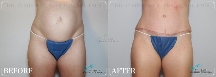 Before & After Tummy Tuck Case 229 Front View in St. Louis, MO