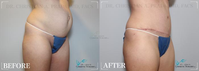 Before & After Tummy Tuck Case 229 Right Oblique View in St. Louis, MO