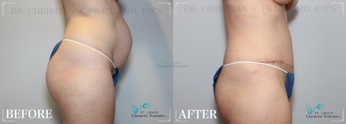 Before & After Tummy Tuck Case 229 Right Side View in St. Louis, MO