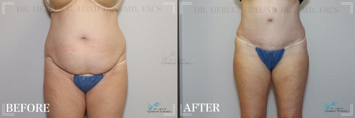 Before & After Tummy Tuck Case 231 Front View in St. Louis, MO