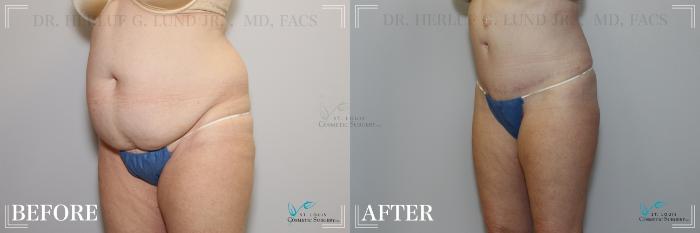 Before & After Tummy Tuck Case 231 Left Oblique View in St. Louis, MO