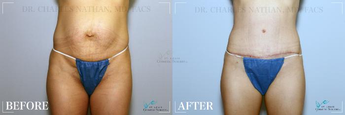 Before & After Tummy Tuck Case 236 Front View in St. Louis, MO
