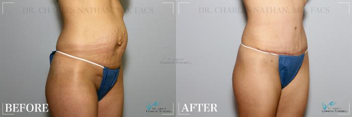 Before & After Tummy Tuck Case 236 Right Oblique View in St. Louis, MO