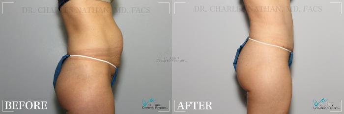 Before & After Tummy Tuck Case 236 Right Side View in St. Louis, MO