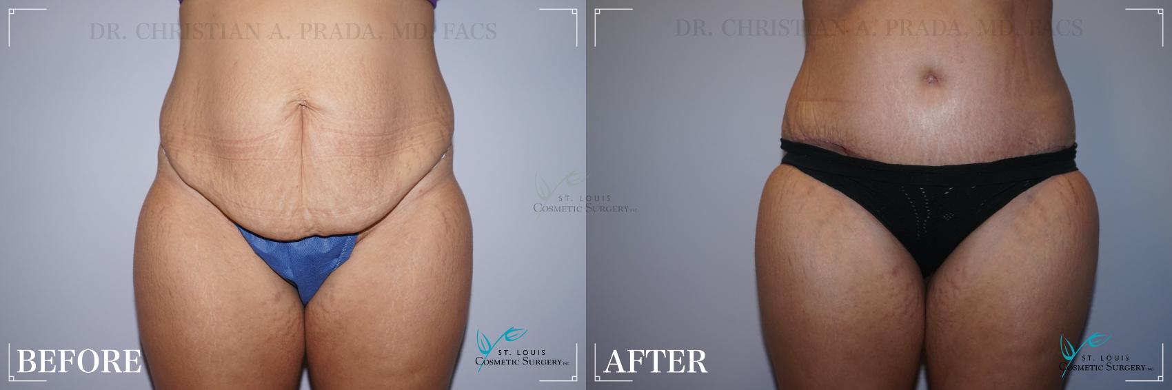Before & After Tummy Tuck Case 243 Front View in St. Louis, MO