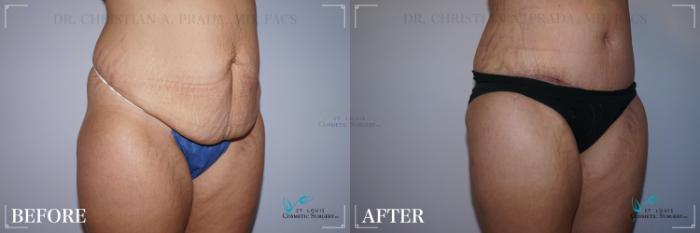 Before & After Tummy Tuck Case 243 Right Oblique View in St. Louis, MO