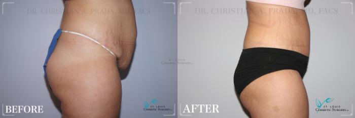 Before & After Tummy Tuck Case 243 Right Side View in St. Louis, MO