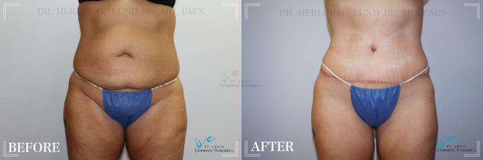 Before & After Tummy Tuck Case 246 Front View in St. Louis, MO