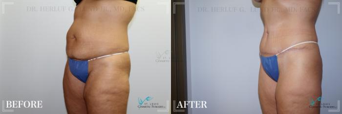 Before & After Tummy Tuck Case 246 Left Oblique View in St. Louis, MO