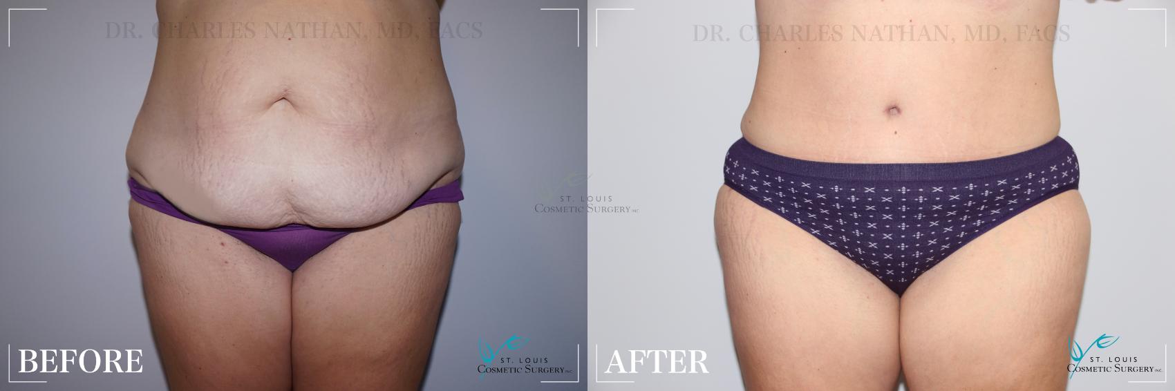 Before & After Tummy Tuck Case 250 Front View in St. Louis, MO