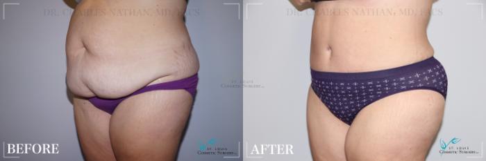 Before & After Tummy Tuck Case 250 Left Oblique View in St. Louis, MO