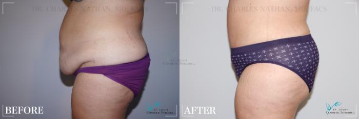 Before & After Tummy Tuck Case 250 Left Side View in St. Louis, MO
