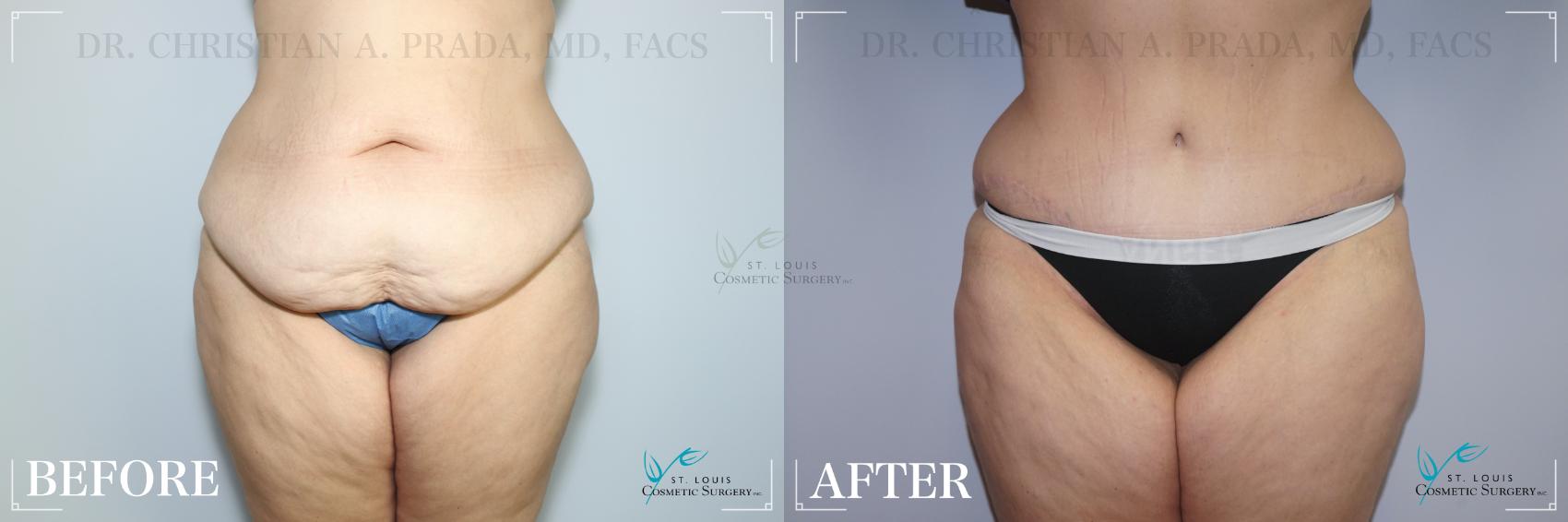 Before & After Tummy Tuck Case 258 Front View in St. Louis, MO