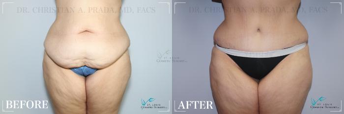 Before & After Tummy Tuck Case 258 Front View in St. Louis, MO