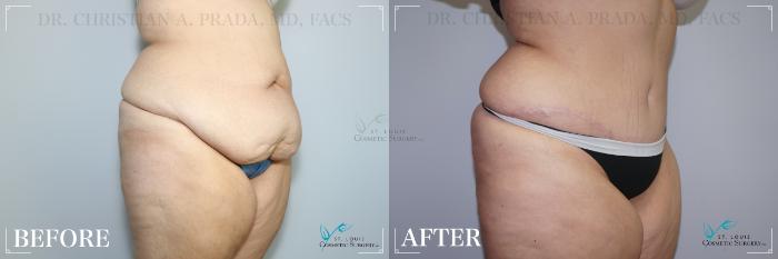 Before & After Tummy Tuck Case 258 Right Oblique View in St. Louis, MO