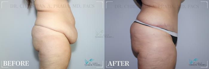 Before & After Tummy Tuck Case 258 Right Side View in St. Louis, MO
