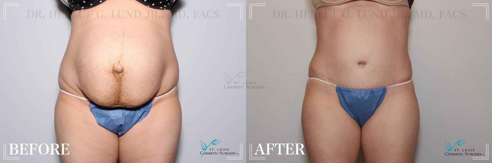 Before & After Tummy Tuck Case 263 Front View in St. Louis, MO