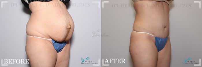Before & After Tummy Tuck Case 263 Right Oblique View in St. Louis, MO