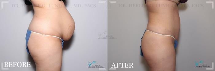 Before & After Tummy Tuck Case 263 Right Side View in St. Louis, MO