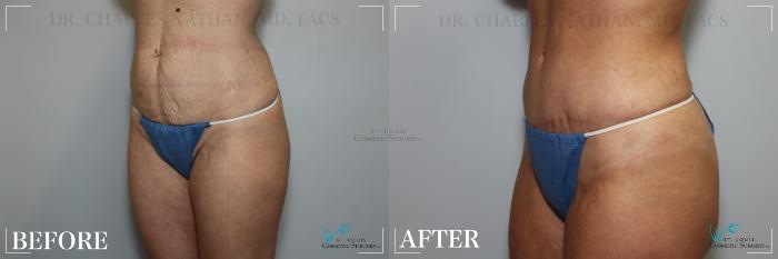 Before & After Tummy Tuck Case 264 Left Oblique View in St. Louis, MO