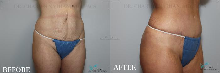 Before & After Tummy Tuck Case 264 Right Oblique View in St. Louis, MO