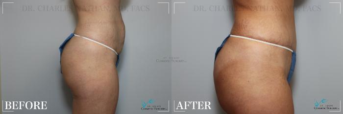 Before & After Tummy Tuck Case 264 Right Side View in St. Louis, MO