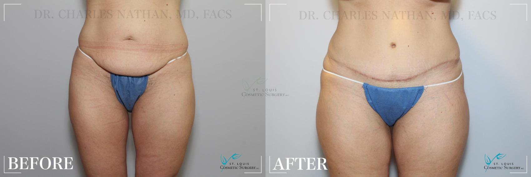 Before & After Tummy Tuck Case 265 Front View in St. Louis, MO