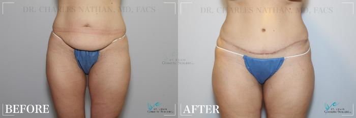 Before & After Tummy Tuck Case 265 Front View in St. Louis, MO
