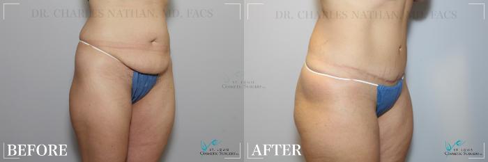 Before & After Tummy Tuck Case 265 Right Oblique View in St. Louis, MO
