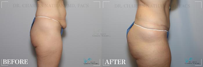Before & After Tummy Tuck Case 265 Right Side View in St. Louis, MO