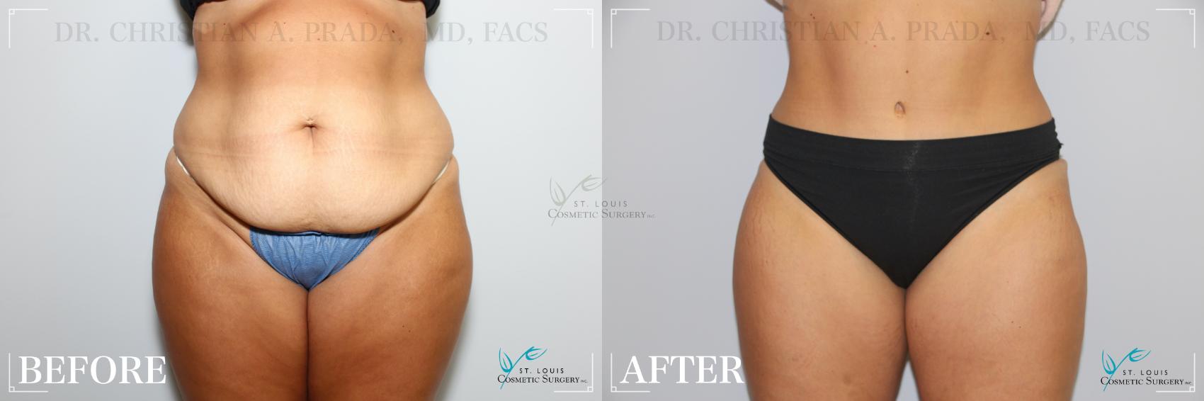 Before & After Tummy Tuck Case 275 Front View in St. Louis, MO