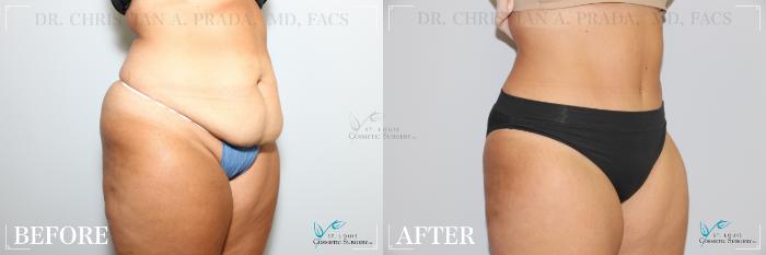 Before & After Tummy Tuck Case 275 Right Oblique View in St. Louis, MO