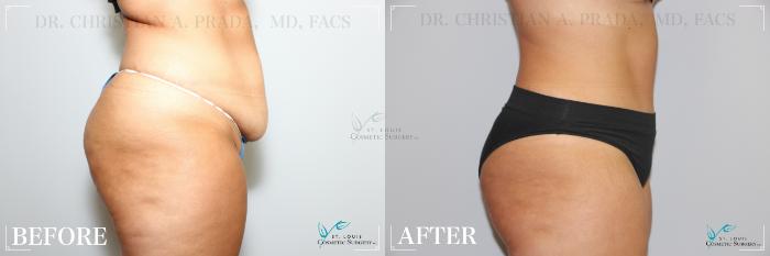 Before & After Tummy Tuck Case 275 Right Side View in St. Louis, MO