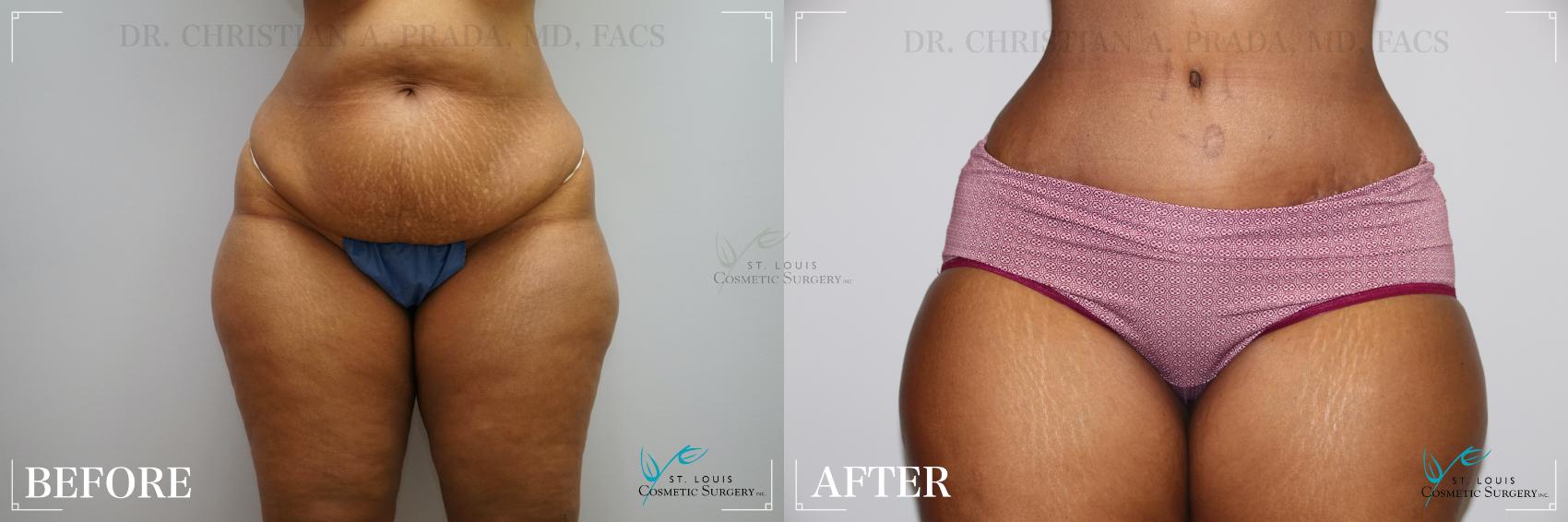 Before & After Tummy Tuck Case 277 Front View in St. Louis, MO