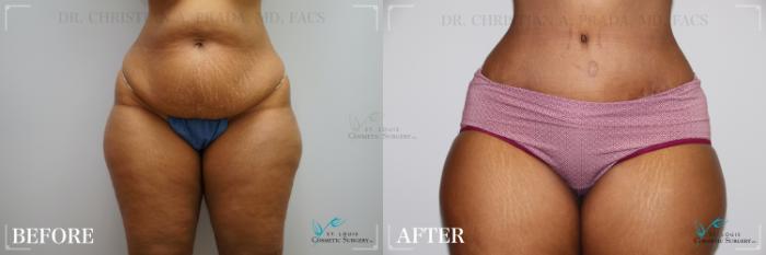 Before & After Tummy Tuck Case 277 Front View in St. Louis, MO