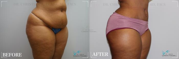 Before & After Tummy Tuck Case 277 Right Oblique View in St. Louis, MO