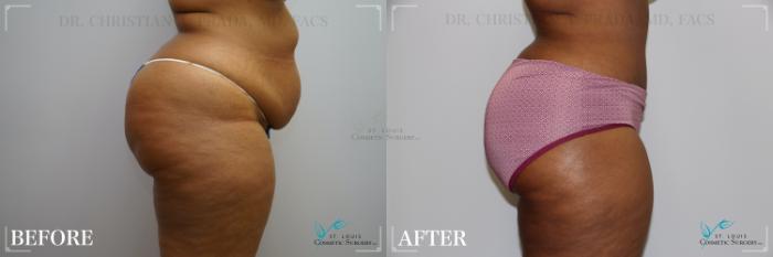 Before & After Tummy Tuck Case 277 Right Side View in St. Louis, MO