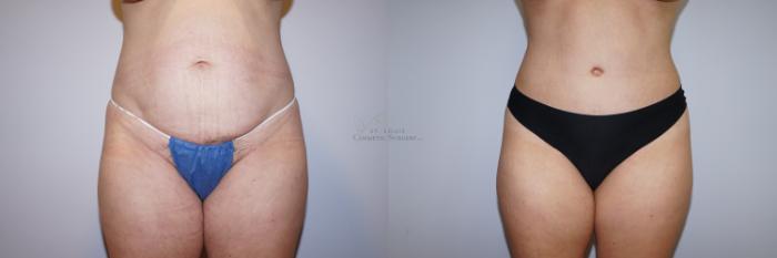 Before & After Tummy Tuck Case 287 Front View in St. Louis, MO