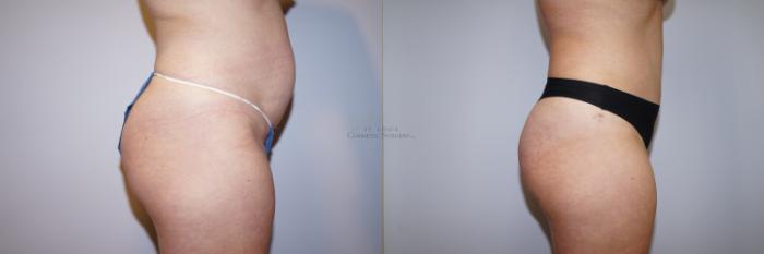 Before & After Tummy Tuck Case 287 Left Side View in St. Louis, MO