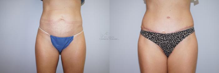 Before & After Tummy Tuck Case 290 Front View in St. Louis, MO