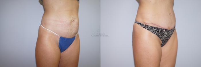 Before & After Tummy Tuck Case 290 Left Oblique View in St. Louis, MO
