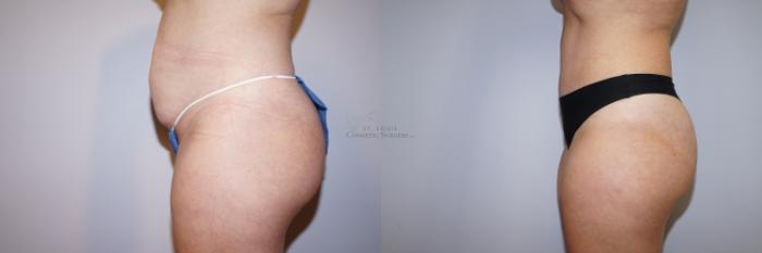 Before & After Tummy Tuck Case 291 Right Side View in St. Louis, MO
