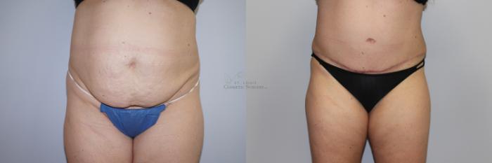 Before & After Tummy Tuck Case 294 Front View in St. Louis, MO